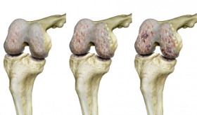 kialakuló arthrosis fájdalomcsillapítók rheumatoid arthritisre